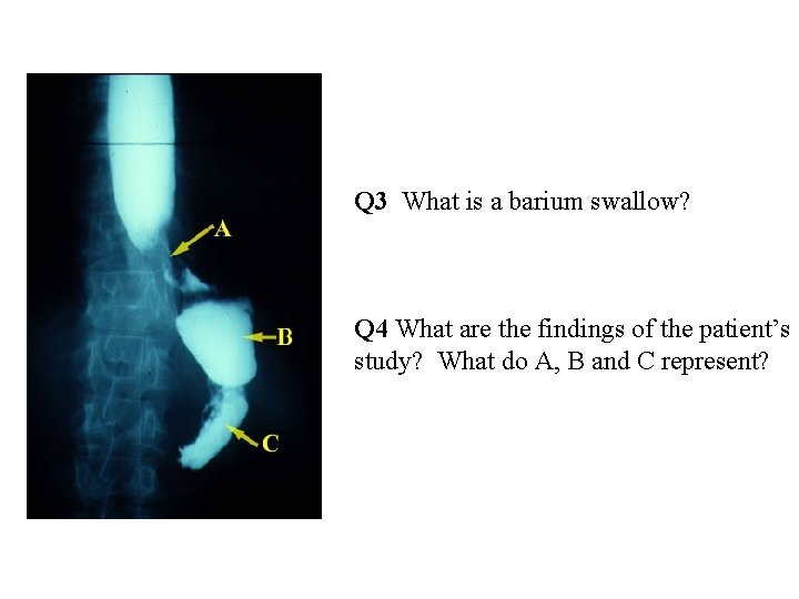 Q 3 What is a barium swallow? Q 4 What are the findings of