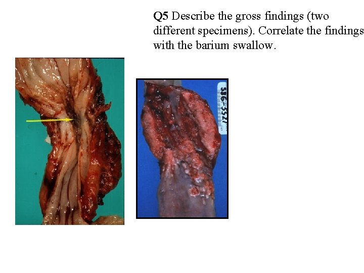 Q 5 Describe the gross findings (two different specimens). Correlate the findings with the