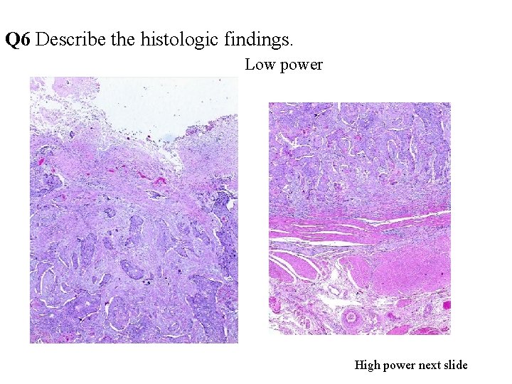 Q 6 Describe the histologic findings. Low power High power next slide 