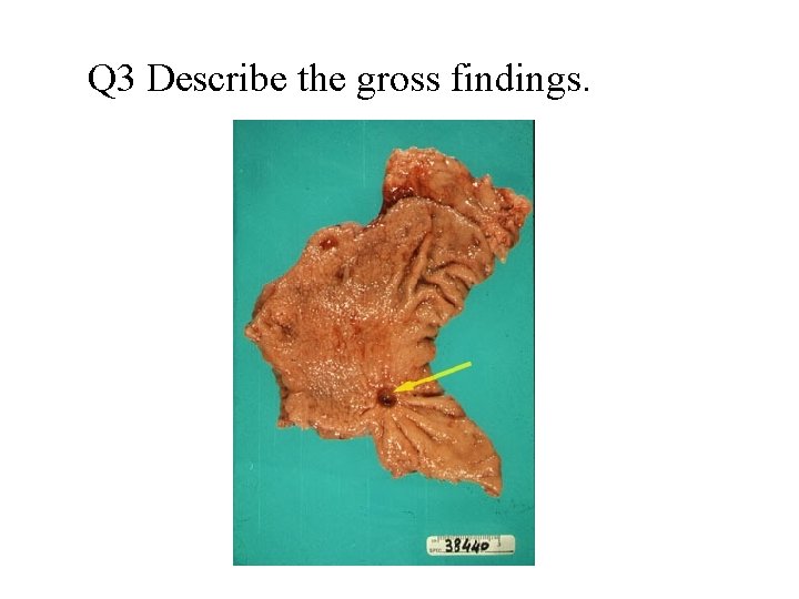 Q 3 Describe the gross findings. 