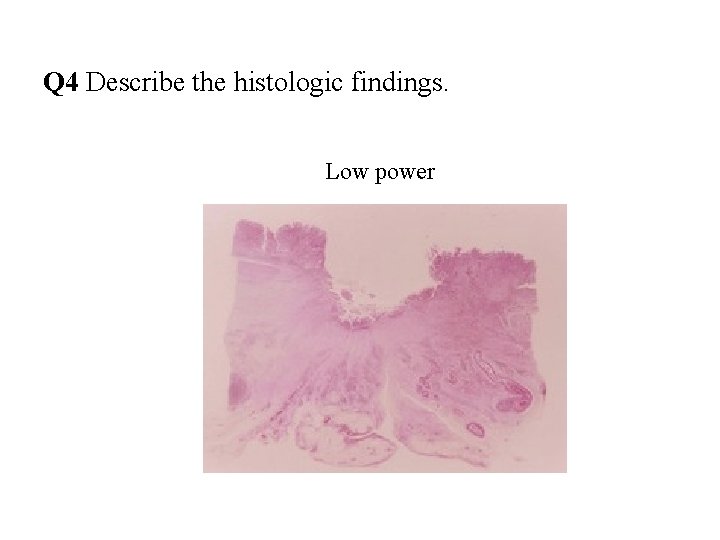 Q 4 Describe the histologic findings. Low power 