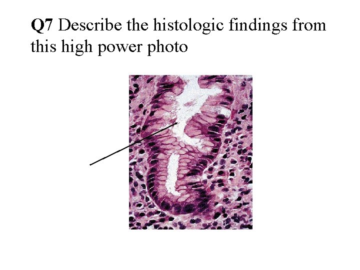 Q 7 Describe the histologic findings from this high power photo 