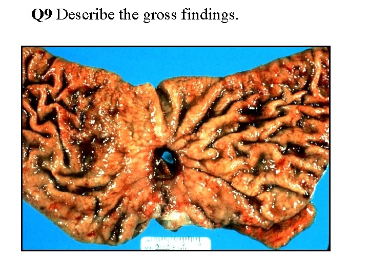 Q 9 Describe the gross findings. 