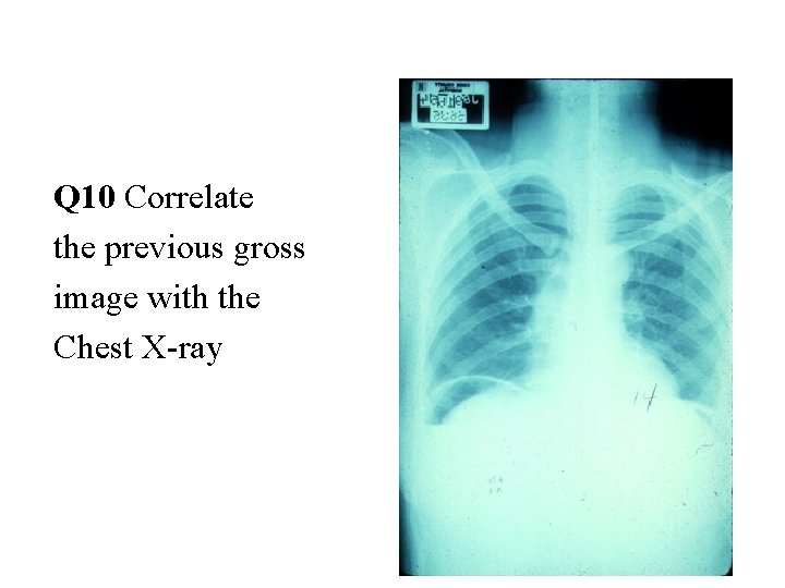 Q 10 Correlate the previous gross image with the Chest X-ray 