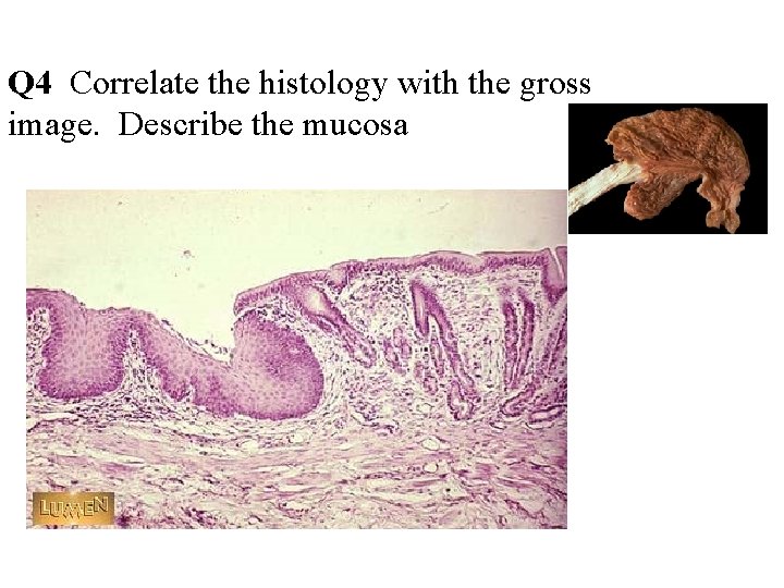 Q 4 Correlate the histology with the gross image. Describe the mucosa 