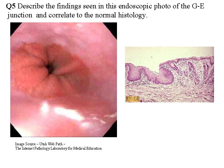 Q 5 Describe the findings seen in this endoscopic photo of the G-E junction