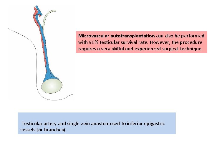 Microvascular autotransplantation can also be performed with 90% testicular survival rate. However, the procedure