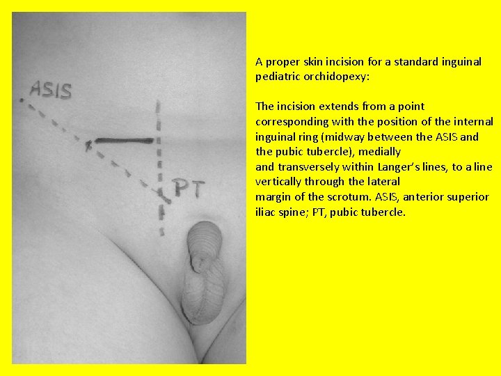 A proper skin incision for a standard inguinal pediatric orchidopexy: The incision extends from