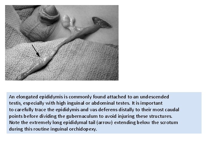 An elongated epididymis is commonly found attached to an undescended testis, especially with high