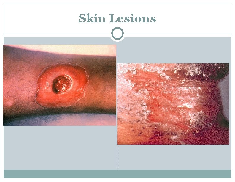 Skin Lesions 