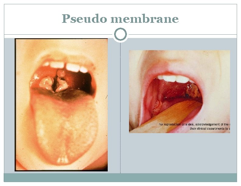 Pseudo membrane 