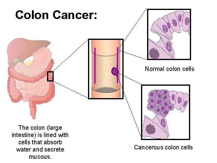 Colon Cancer: Normal colon cells The colon (large intestine) is lined with cells that