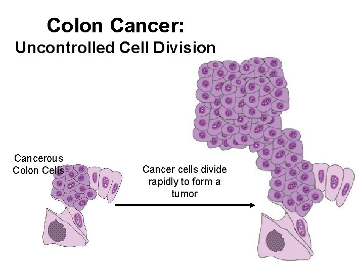 Colon Cancer: Uncontrolled Cell Division Cancerous Colon Cells Cancer cells divide rapidly to form