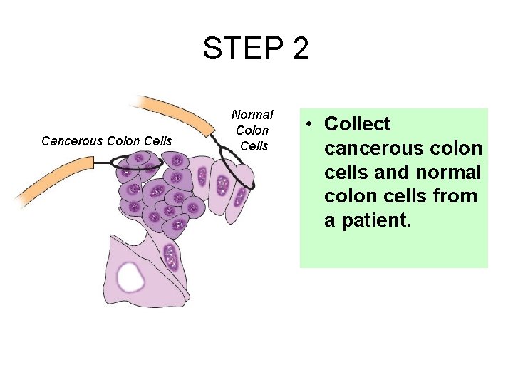 STEP 2 Cancerous Colon Cells Normal Colon Cells • Collect cancerous colon cells and