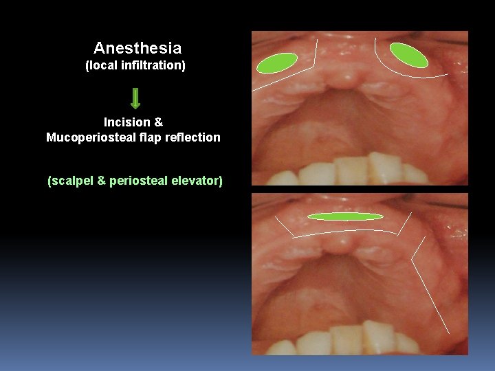 Anesthesia (local infiltration) Incision & Mucoperiosteal flap reflection (scalpel & periosteal elevator) 