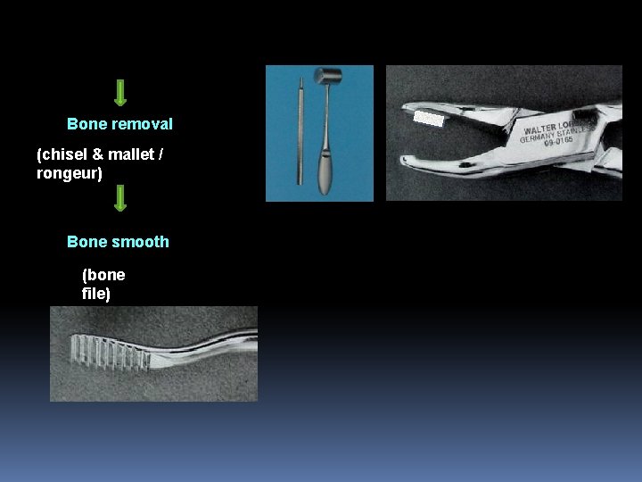 Bone removal (chisel & mallet / rongeur) Bone smooth (bone file) 