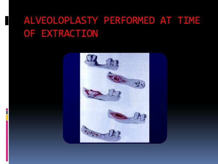 ALVEOLOPLASTY PERFORMED AT TIME OF EXTRACTION 