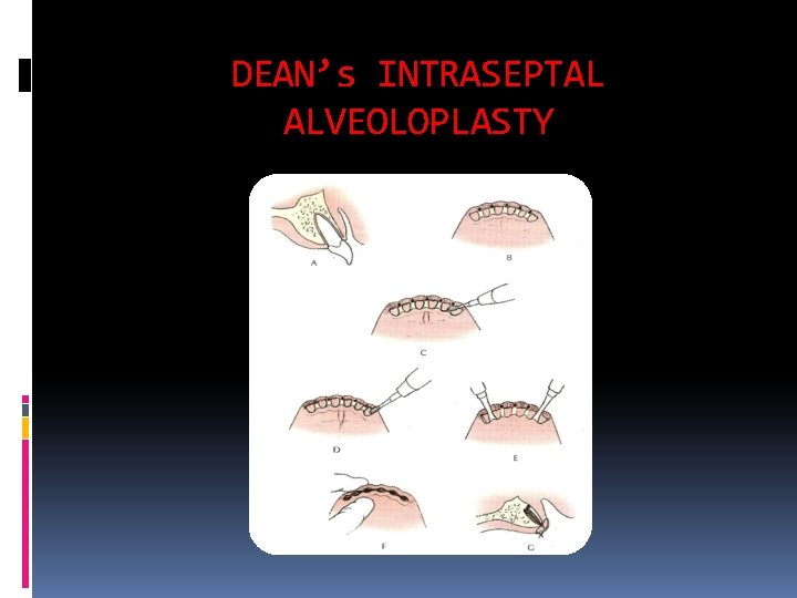 DEAN’s INTRASEPTAL ALVEOLOPLASTY 