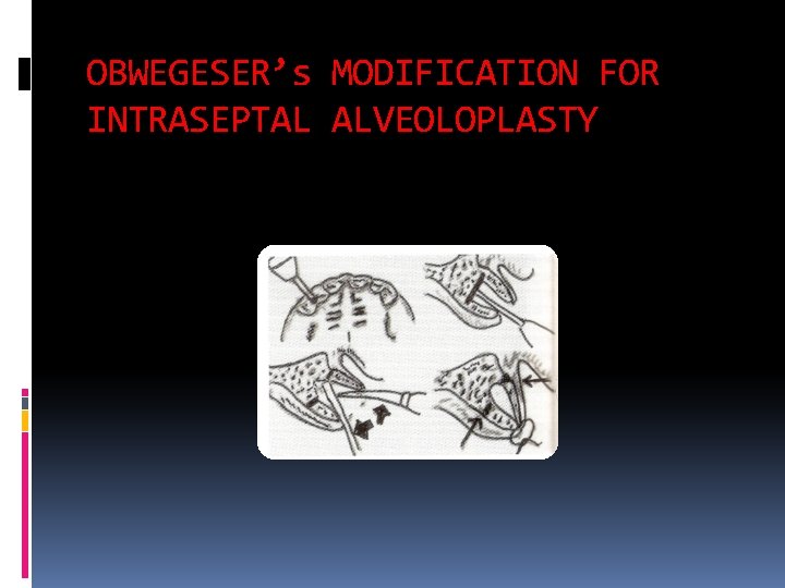 OBWEGESER’s MODIFICATION FOR INTRASEPTAL ALVEOLOPLASTY 