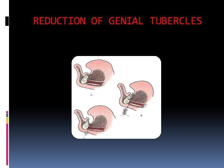 REDUCTION OF GENIAL TUBERCLES 