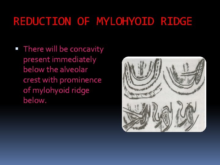 REDUCTION OF MYLOHYOID RIDGE There will be concavity present immediately below the alveolar crest