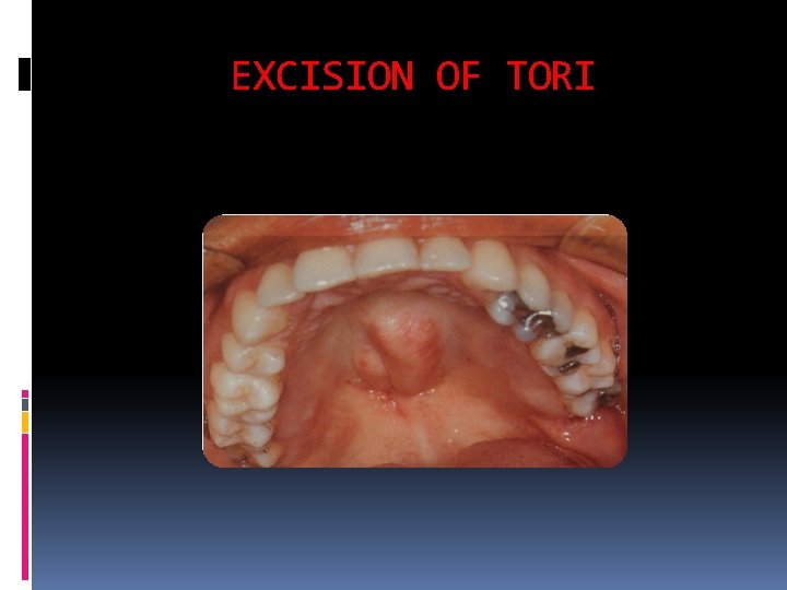 EXCISION OF TORI 