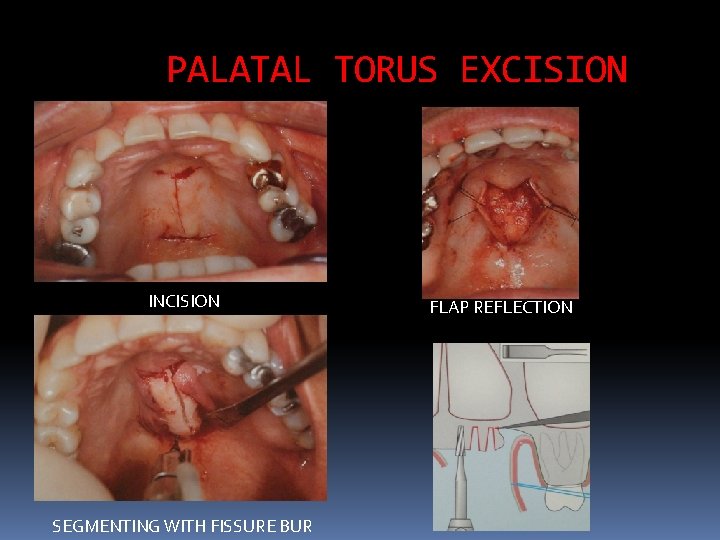 PALATAL TORUS EXCISION INCISION SEGMENTING WITH FISSURE BUR FLAP REFLECTION 