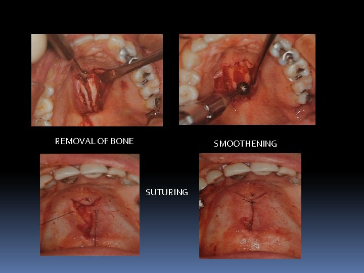 REMOVAL OF BONE SMOOTHENING SUTURING 