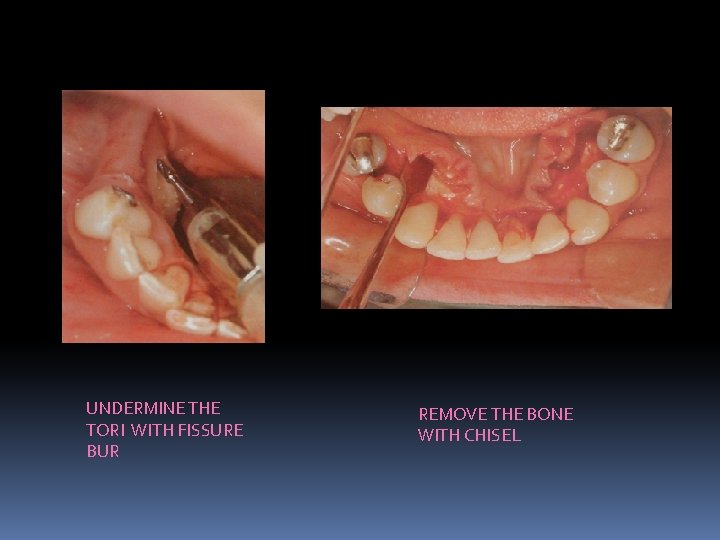 UNDERMINE THE TORI WITH FISSURE BUR REMOVE THE BONE WITH CHISEL 