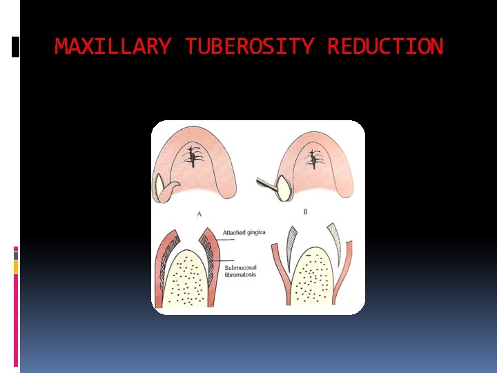 MAXILLARY TUBEROSITY REDUCTION 