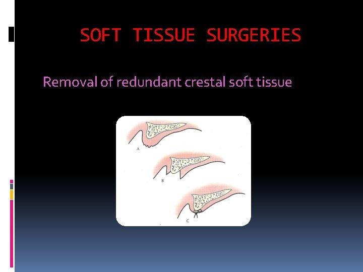 SOFT TISSUE SURGERIES Removal of redundant crestal soft tissue 