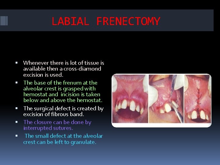 LABIAL FRENECTOMY Whenever there is lot of tissue is available then a cross diamond