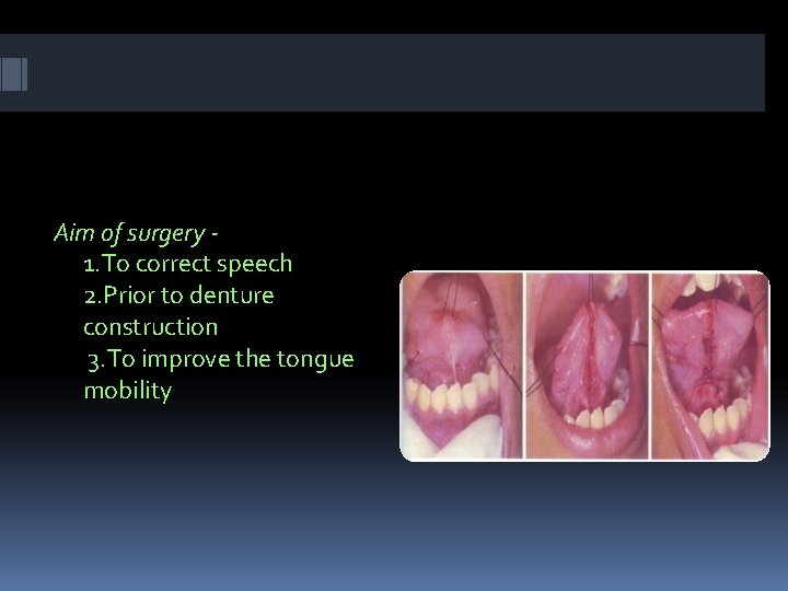 Aim of surgery 1. To correct speech 2. Prior to denture construction 3. To