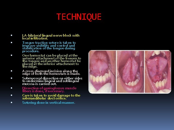 TECHNIQUE LA bilateral lingual nerve block with local infiltration. Tongue traction suture is taken