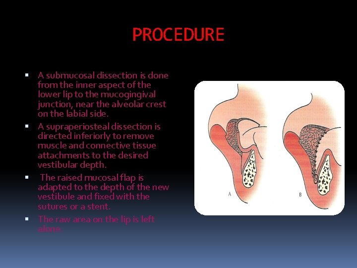 PROCEDURE A submucosal dissection is done from the inner aspect of the lower lip