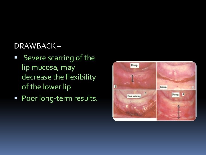 DRAWBACK – Severe scarring of the lip mucosa, may decrease the flexibility of the