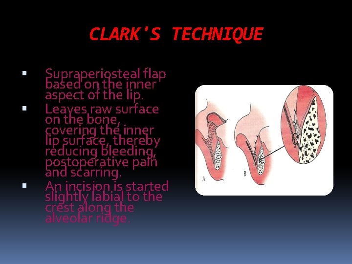 CLARK'S TECHNIQUE Supraperiosteal flap based on the inner aspect of the lip. Leaves raw