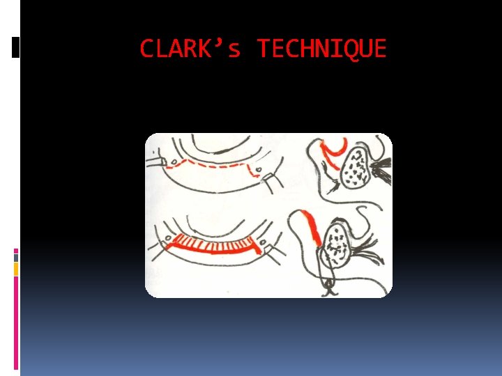 CLARK’s TECHNIQUE 