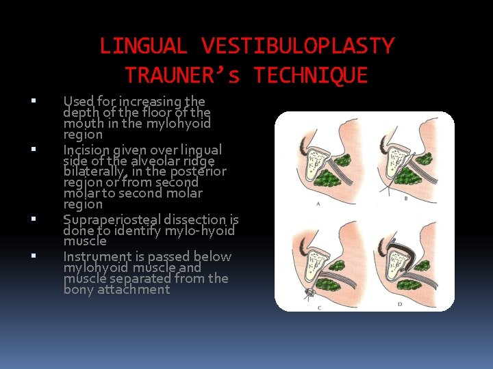 LINGUAL VESTIBULOPLASTY TRAUNER’s TECHNIQUE Used for increasing the depth of the floor of the