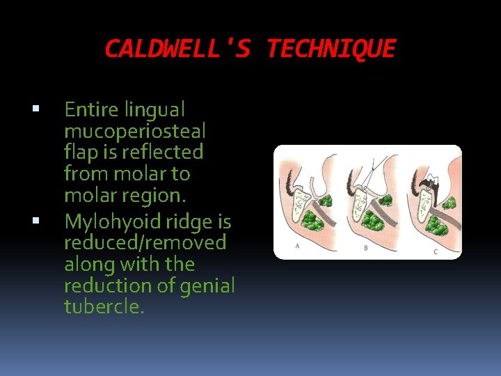 CALDWELL'S TECHNIQUE Entire lingual mucoperiosteal flap is reflected from molar to molar region. Mylohyoid