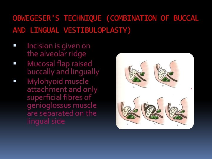 OBWEGESER'S TECHNIQUE (COMBINATION OF BUCCAL AND LINGUAL VESTIBULOPLASTY) Incision is given on the alveolar