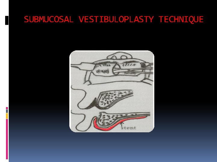 SUBMUCOSAL VESTIBULOPLASTY TECHNIQUE 