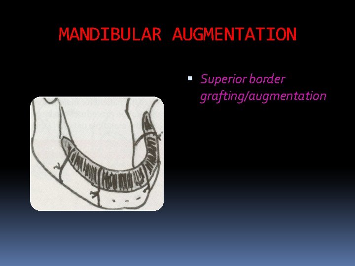 MANDIBULAR AUGMENTATION Superior border grafting/augmentation 