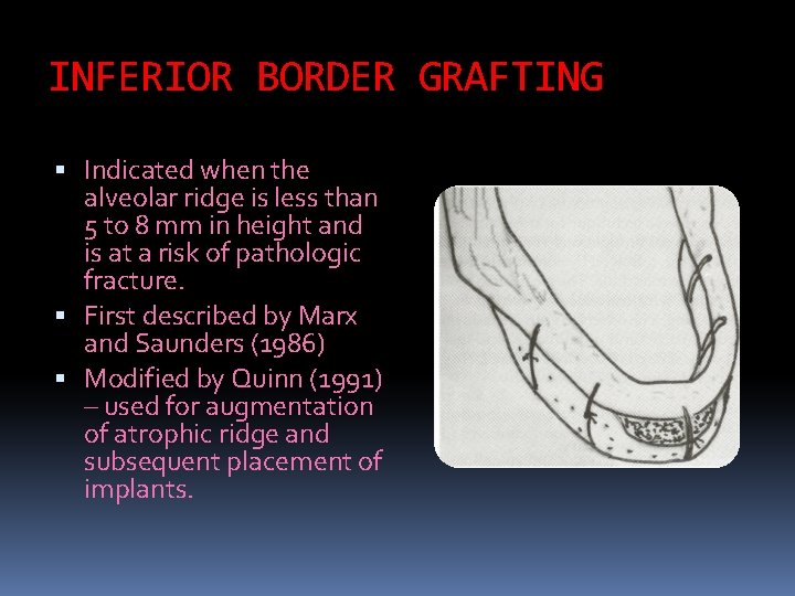 INFERIOR BORDER GRAFTING Indicated when the alveolar ridge is less than 5 to 8