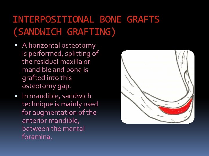INTERPOSITIONAL BONE GRAFTS (SANDWICH GRAFTING) A horizontal osteotomy is performed, splitting of the residual
