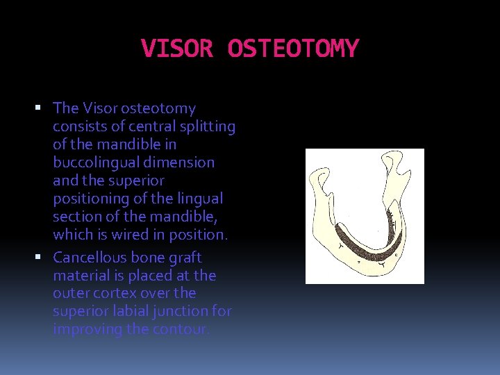 VISOR OSTEOTOMY The Visor osteotomy consists of central splitting of the mandible in buccolingual