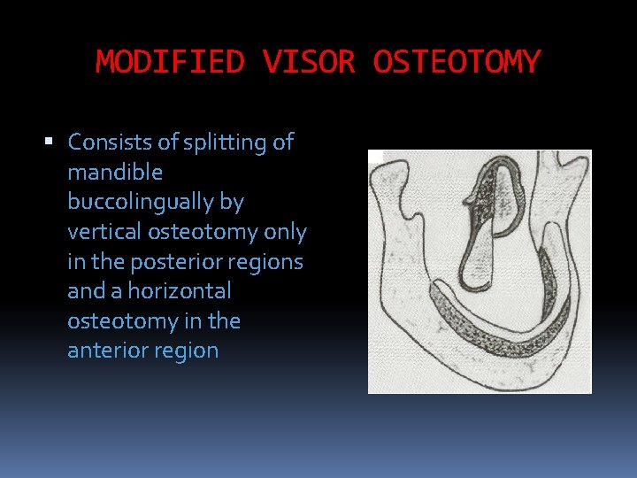 MODIFIED VISOR OSTEOTOMY Consists of splitting of mandible buccolingually by vertical osteotomy only in