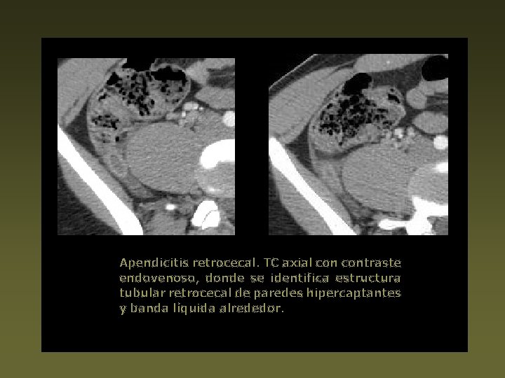 Apendicitis retrocecal. TC axial contraste endovenoso, donde se identifica estructura tubular retrocecal de paredes