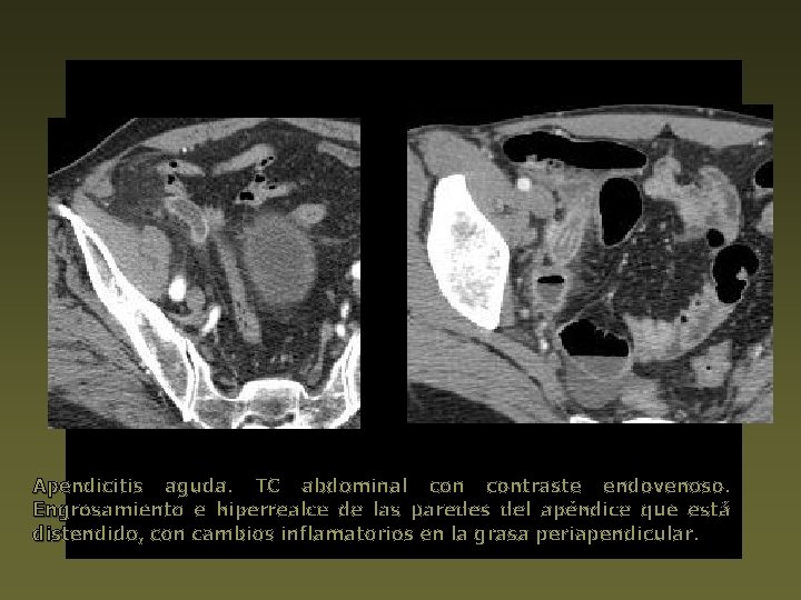 Apendicitis aguda. TC abdominal contraste endovenoso. Engrosamiento e hiperrealce de las paredes del apéndice