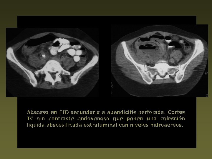 Absceso en FID secundaria a apendicitis perforada. Cortes TC sin contraste endovenoso que ponen